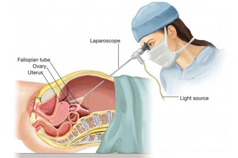 Laparoscopy Diagnostic