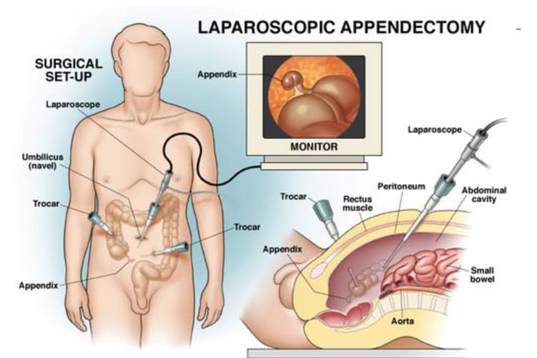 Laparoscopy Appendix