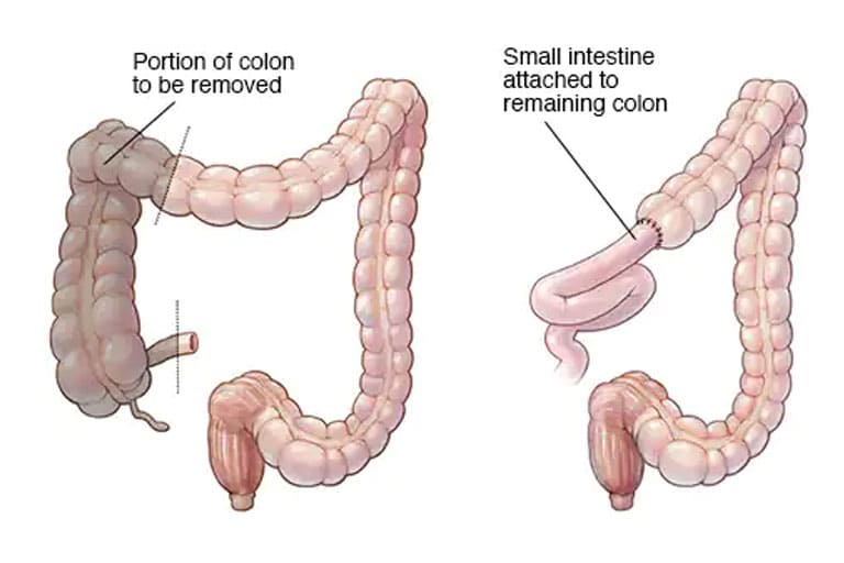Colectomy