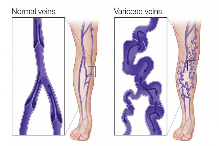 Vericose & Veins